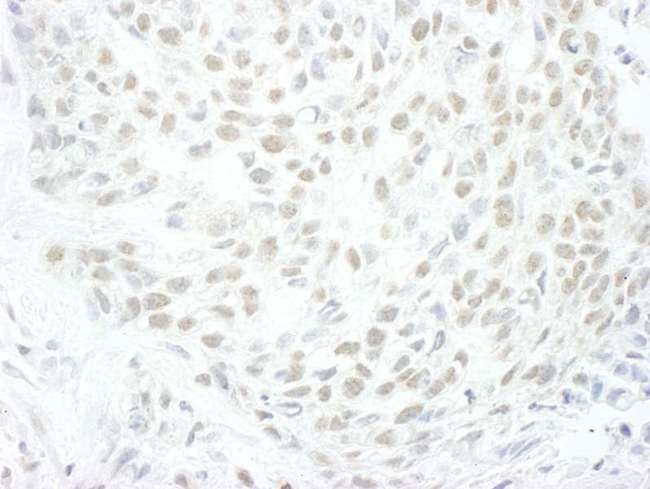ENL / MLLT1 Antibody - Detection of Human MLLT1by Immunohistochemistry. Sample: FFPE section of human skin carcinoma. Antibody: Affinity purified rabbit anti-MLLT1 used at a dilution of 1:250.