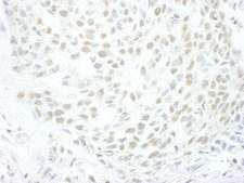 ENL / MLLT1 Antibody - Detection of Human MLLT1by Immunohistochemistry. Sample: FFPE section of human skin carcinoma. Antibody: Affinity purified rabbit anti-MLLT1 used at a dilution of 1:250.