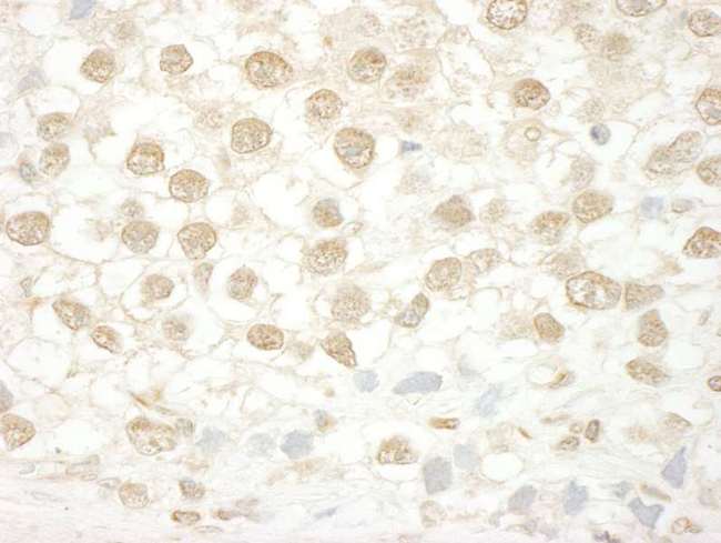 ENL / MLLT1 Antibody - Detection of Human MLLT1 by Immunohistochemistry. Sample: FFPE section of human testicular seminoma. Antibody: Affinity purified rabbit anti-MLLT1 used at a dilution of 1:200 (1 ug/ml). Detection: DAB.