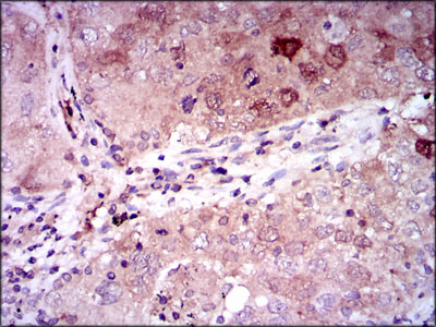 ENO2 / NSE Antibody - IHC of paraffin-embedded lung cancer tissues using ENO2 mouse monoclonal antibody with DAB staining.