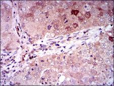 ENO2 / NSE Antibody - IHC of paraffin-embedded lung cancer tissues using ENO2 mouse monoclonal antibody with DAB staining.