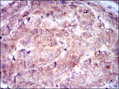 ENO2 / NSE Antibody - IHC of paraffin-embedded liver cancer tissues using ENO2 mouse monoclonal antibody with DAB staining.