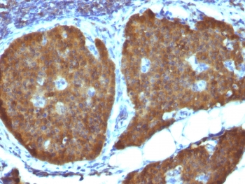 ENO2 / NSE Antibody - IHC testing of FFPE human pheochromocytoma with NSE antibody (clone ENO2/1462). Required HIER: boil sections in 10mM citrate buffer, pH6, for 10-20 min.