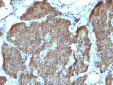ENO2 / NSE Antibody - IHC testing of FFPE human pheochromocytoma with NSE antibody (clone SPM347). Required HIER: boil sections in 10mM citrate buffer, pH6, for 10-20 min.