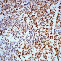 ENO2 / NSE Antibody - Immunohistochemical analysis of Gamma-enolase staining in human lung cancer formalin fixed paraffin embedded tissue section. The section was pre-treated using heat mediated antigen retrieval with sodium citrate buffer (pH 6.0). The section was then incubated with the antibody at room temperature and detected using an HRP conjugated compact polymer system. DAB was used as the chromogen. The section was then counterstained with hematoxylin and mounted with DPX.