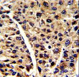 ENO3 / Enolase 3 Antibody - Formalin-fixed and paraffin-embedded human hepatocarcinoma reacted with ENOB Antibody , which was peroxidase-conjugated to the secondary antibody, followed by DAB staining. This data demonstrates the use of this antibody for immunohistochemistry; clinical relevance has not been evaluated.