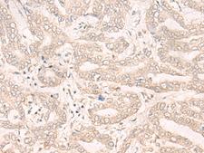 ENO4 Antibody - Immunohistochemistry of paraffin-embedded Human liver cancer tissue  using ENO4 Polyclonal Antibody at dilution of 1:30(×200)