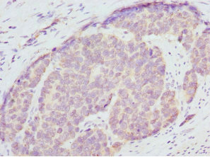ENOX2 Antibody - Immunohistochemistry of paraffin-embedded human gastric cancer at dilution 1:100