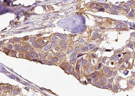 ENOX2 Antibody - 1:100 staining human breast carcinoma tissue by IHC-P. The sample was formaldehyde fixed and a heat mediated antigen retrieval step in citrate buffer was performed. The sample was then blocked and incubated with the antibody for 1.5 hours at 22°C. An HRP conjugated goat anti-rabbit antibody was used as the secondary.