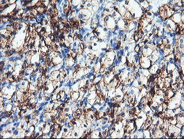 ENPEP / Aminopeptidase A Antibody - IHC of paraffin-embedded Carcinoma of Human kidney tissue using anti-ENPEP mouse monoclonal antibody.