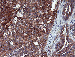 ENPEP / Aminopeptidase A Antibody - IHC of paraffin-embedded Adenocarcinoma of Human ovary tissue using anti-ENPEP mouse monoclonal antibody. (Heat-induced epitope retrieval by 10mM citric buffer, pH6.0, 100C for 10min).