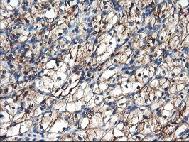 ENPEP / Aminopeptidase A Antibody - IHC of paraffin-embedded Carcinoma of Human kidney tissue using anti-ENPEP mouse monoclonal antibody. (Heat-induced epitope retrieval by 10mM citric buffer, pH6.0, 100C for 10min).