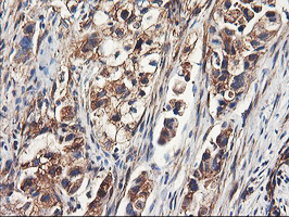ENPEP / Aminopeptidase A Antibody - IHC of paraffin-embedded Carcinoma of Human lung tissue using anti-ENPEP mouse monoclonal antibody. (Heat-induced epitope retrieval by 10mM citric buffer, pH6.0, 100C for 10min).