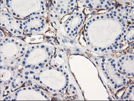 ENPEP / Aminopeptidase A Antibody - IHC of paraffin-embedded Carcinoma of Human thyroid tissue using anti-ENPEP mouse monoclonal antibody. (Heat-induced epitope retrieval by 10mM citric buffer, pH6.0, 100C for 10min).