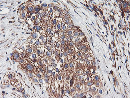 ENPEP / Aminopeptidase A Antibody - IHC of paraffin-embedded Carcinoma of Human bladder tissue using anti-ENPEP mouse monoclonal antibody. (Heat-induced epitope retrieval by 10mM citric buffer, pH6.0, 100C for 10min).