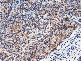 ENPEP / Aminopeptidase A Antibody - IHC of paraffin-embedded Human lymphoma tissue using anti-ENPEP mouse monoclonal antibody. (Heat-induced epitope retrieval by 10mM citric buffer, pH6.0, 100C for 10min).