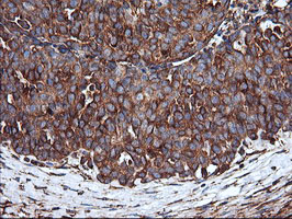 ENPEP / Aminopeptidase A Antibody - IHC of paraffin-embedded Adenocarcinoma of Human ovary tissue using anti-ENPEP mouse monoclonal antibody. (Heat-induced epitope retrieval by 10mM citric buffer, pH6.0, 100C for 10min).