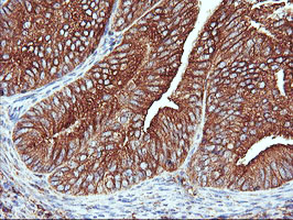ENPEP / Aminopeptidase A Antibody - IHC of paraffin-embedded Adenocarcinoma of Human endometrium tissue using anti-ENPEP mouse monoclonal antibody. (Heat-induced epitope retrieval by 10mM citric buffer, pH6.0, 100C for 10min).