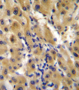 ENPP2 / Autotaxin Antibody - ENPP2 Antibody (Center K416) immunohistochemistry of formalin-fixed and paraffin-embedded human hepatocarcinoma followed by peroxidase-conjugated secondary antibody and DAB staining.
