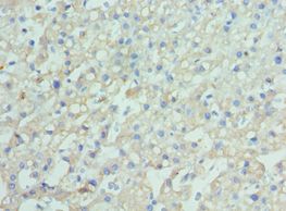 ENPP2 / Autotaxin Antibody - Immunohistochemistry of paraffin-embedded human liver cancer using antibody at 1:100 dilution.