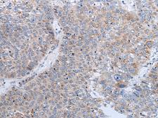 ENPP2 / Autotaxin Antibody - Immunohistochemistry of paraffin-embedded Human liver cancer tissue  using ENPP2 Polyclonal Antibody at dilution of 1:50(×200)