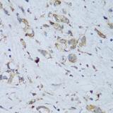 ENPP3 / CD203c Antibody - Immunohistochemistry of paraffin-embedded Human gastric cancer using ENPP3 Polyclonal Antibody at dilution of 1:150 (40x lens).