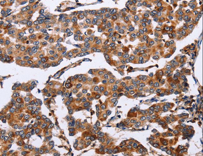 ENPP5 Antibody - Immunohistochemistry of paraffin-embedded Human ovarian cancer using ENPP5 Polyclonal Antibody at dilution of 1:60.