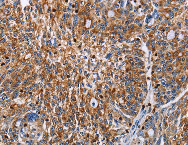ENPP5 Antibody - Immunohistochemistry of paraffin-embedded Human ovarian cancer using ENPP5 Polyclonal Antibody at dilution of 1:60.