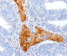 ENPP7 Antibody - Immunohistochemistry of paraffin-embedded human cervical cancer tissue.
