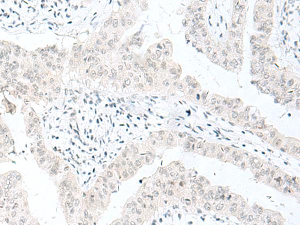 ENSA Antibody - Immunohistochemistry of paraffin-embedded Human liver cancer tissue  using ENSA Polyclonal Antibody at dilution of 1:70(×200)