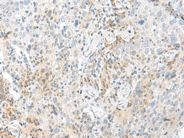 ENSA Antibody - Immunohistochemistry of paraffin-embedded Human cervical cancer tissue  using ENSA Polyclonal Antibody at dilution of 1:70(×200)