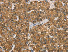 ENTPD5 / CD39L4 Antibody - Immunohistochemistry of paraffin-embedded Human liver cancer using ENTPD5 Polyclonal Antibody at dilution of 1:20.