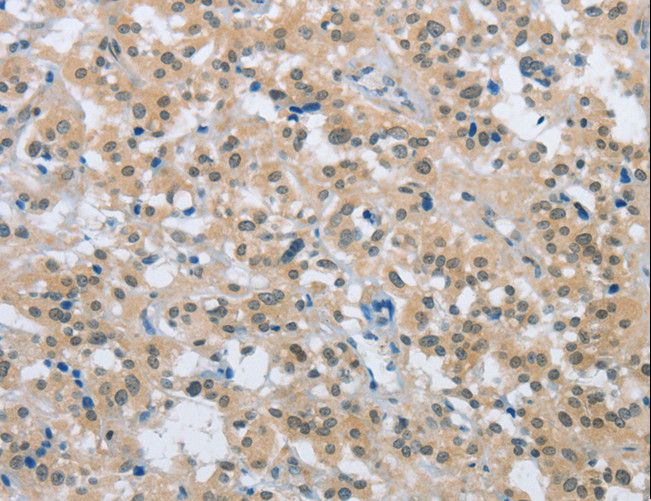 ENTPD5 / CD39L4 Antibody - Immunohistochemistry of paraffin-embedded Human thyroid cancer using ENTPD5 Polyclonal Antibody at dilution of 1:20.