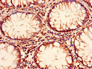 ENTPD8 Antibody - Immunohistochemistry of paraffin-embedded human colon cancer using ENTPD8 Antibody at dilution of 1:100