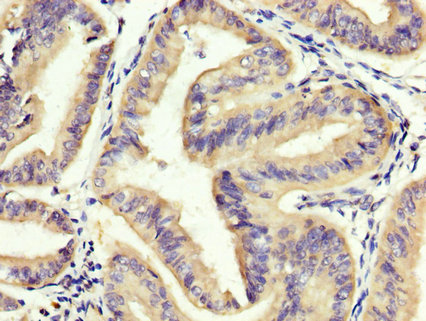 Eomesodermin / EOMES Antibody - Immunohistochemistry image at a dilution of 1:400 and staining in paraffin-embedded human endometrial cancer performed on a Leica BondTM system. After dewaxing and hydration, antigen retrieval was mediated by high pressure in a citrate buffer (pH 6.0) . Section was blocked with 10% normal goat serum 30min at RT. Then primary antibody (1% BSA) was incubated at 4 °C overnight. The primary is detected by a biotinylated secondary antibody and visualized using an HRP conjugated SP system.