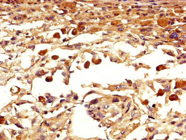 Eomesodermin / EOMES Antibody - Immunohistochemistry image at a dilution of 1:400 and staining in paraffin-embedded human melanoma cancer performed on a Leica BondTM system. After dewaxing and hydration, antigen retrieval was mediated by high pressure in a citrate buffer (pH 6.0) . Section was blocked with 10% normal goat serum 30min at RT. Then primary antibody (1% BSA) was incubated at 4 °C overnight. The primary is detected by a biotinylated secondary antibody and visualized using an HRP conjugated SP system.
