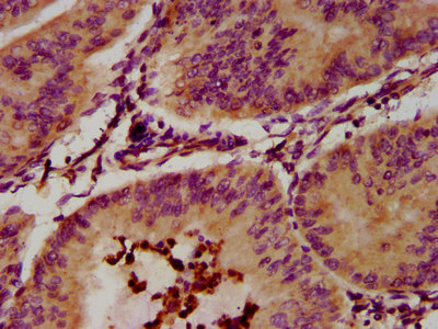 Eosinophil Peroxidase / EPX Antibody - Immunohistochemistry image at a dilution of 1:300 and staining in paraffin-embedded human endometrial cancer performed on a Leica BondTM system. After dewaxing and hydration, antigen retrieval was mediated by high pressure in a citrate buffer (pH 6.0) . Section was blocked with 10% normal goat serum 30min at RT. Then primary antibody (1% BSA) was incubated at 4 °C overnight. The primary is detected by a biotinylated secondary antibody and visualized using an HRP conjugated SP system.