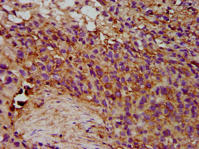 Eosinophil Peroxidase / EPX Antibody - Immunohistochemistry image at a dilution of 1:300 and staining in paraffin-embedded human ovarian cancer performed on a Leica BondTM system. After dewaxing and hydration, antigen retrieval was mediated by high pressure in a citrate buffer (pH 6.0) . Section was blocked with 10% normal goat serum 30min at RT. Then primary antibody (1% BSA) was incubated at 4 °C overnight. The primary is detected by a biotinylated secondary antibody and visualized using an HRP conjugated SP system.