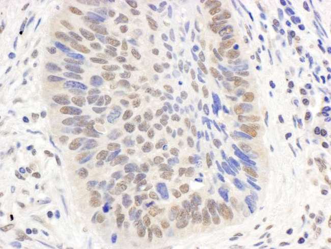 EP300 / p300 Antibody - Detection of Human p300 by Immunohistochemistry. Sample: FFPE section of human lung carcinoma. Antibody: Affinity purified rabbit anti-p300 used at a dilution of 1:5000 (0.2 ug/ml). Detection: DAB.