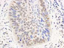 EP300 / p300 Antibody - Detection of Human p300 by Immunohistochemistry. Sample: FFPE section of human lung carcinoma. Antibody: Affinity purified rabbit anti-p300 used at a dilution of 1:5000 (0.2 ug/ml). Detection: DAB.