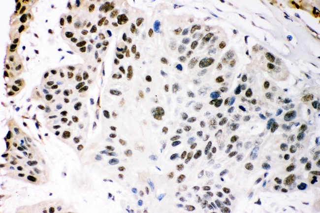 EP300 / p300 Antibody - KAT3B/p300 antibody IHC-paraffin: Human Esophagus Squamous Cancer Tissue.