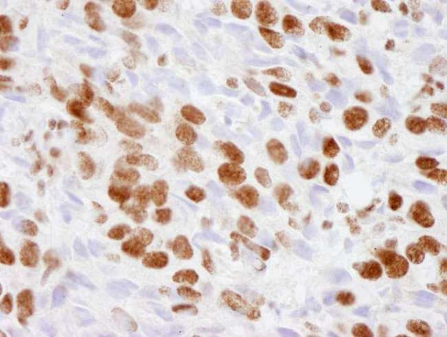 EP300 / p300 Antibody - Detection of Human p300 by Immunohistochemistry. Sample: FFPE section of human breast adenocarcinoma.. Antibody: Affinity purified rabbit anti-p300 used at a dilution of 1:250. Detection: DAB.