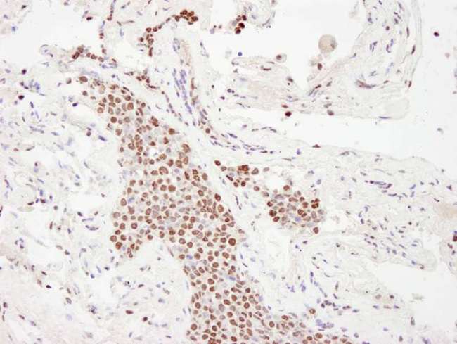 EP300 / p300 Antibody - Detection of Human p300 by Immunohistochemistry. Samples: FFPE section of small cell lung carcinoma. Antibody: Affinity purified rabbit anti-p300 used at a dilution of 1:250. Detection: DAB.