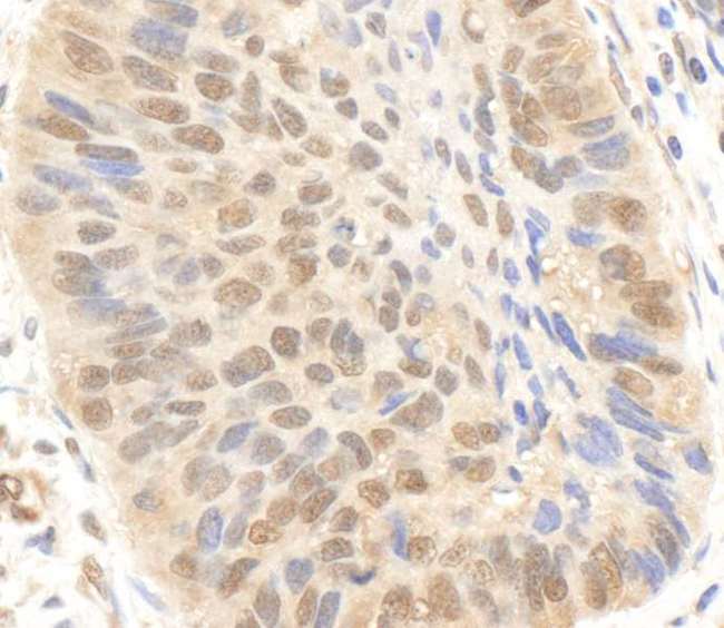 EP300 / p300 Antibody - Detection of Human p300 by Immunohistochemistry. Sample: FFPE section of human lung carcinoma. Antibody: Affinity purified rabbit anti-p300 used at a dilution of 1:1000 (1 ug/ml). Detection: DAB.