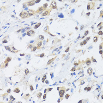 EP300 / p300 Antibody - Immunohistochemistry of paraffin-embedded human lung cancer using EP300 antibody at dilution of 1:100 (40x lens).