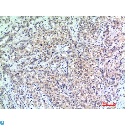 EP300 / p300 Antibody - Immunohistochemistry (IHC) analysis of paraffin-embedded Human Breast Cancer, antibody was diluted at 1:200.