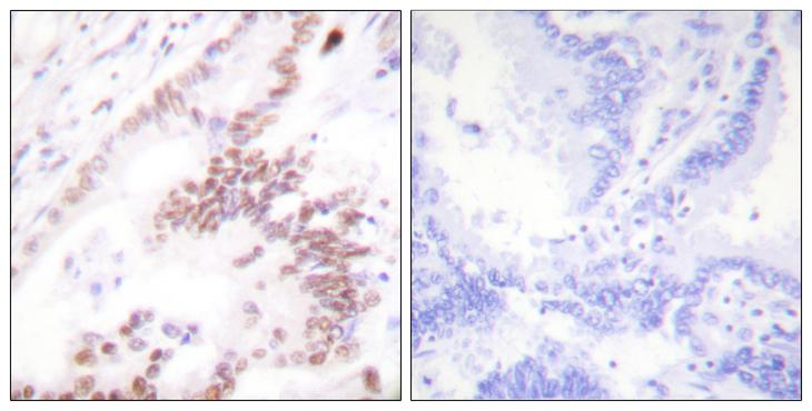 EP300 / p300 Antibody - Peptide - + Immunohistochemistry analysis of paraffin-embedded human lung carcinoma tissue using p300 antibody.