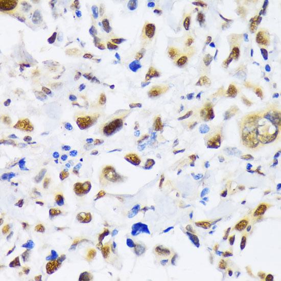 EP300 / p300 Antibody - Immunohistochemistry of paraffin-embedded Human lung cancer using EP300 Polyclonal Antibody at dilution of 1:100 (40x lens).