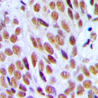 EP300 / p300 Antibody - Immunohistochemical analysis of p300 staining in human breast cancer formalin fixed paraffin embedded tissue section. The section was pre-treated using heat mediated antigen retrieval with sodium citrate buffer (pH 6.0). The section was then incubated with the antibody at room temperature and detected using an HRP polymer system. DAB was used as the chromogen. The section was then counterstained with hematoxylin and mounted with DPX.