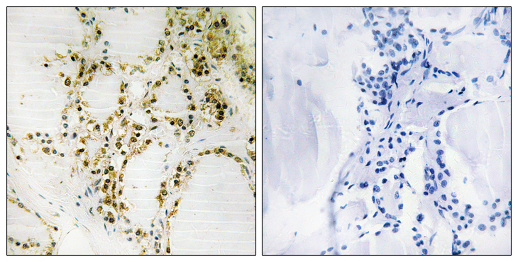 EP300 / p300 Antibody - Immunohistochemistry analysis of paraffin-embedded human thyroid gland, using p300 (Phospho-Ser89) Antibody. The picture on the right is blocked with the phospho peptide.